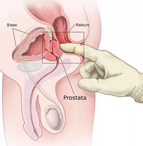 Prostata -Massage